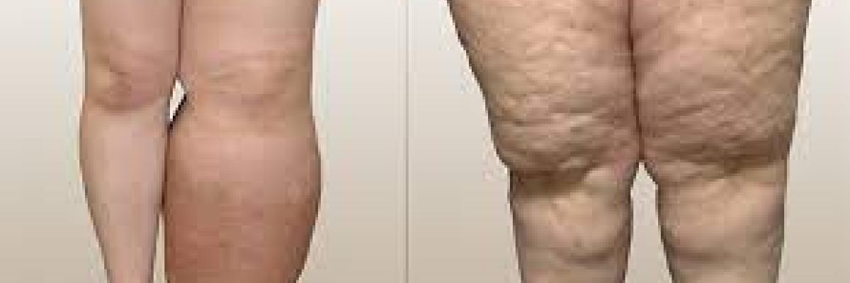 Linfedema y Lipedema: Diferencias y Similitudes en su Tratamiento